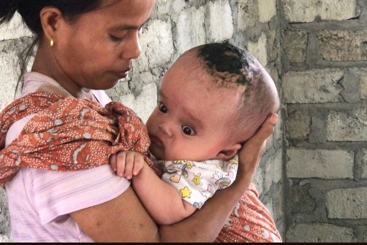 Kemensos Bantu Bayi Penderita Hidrosefalus Asal Desa Terong- Manggarai